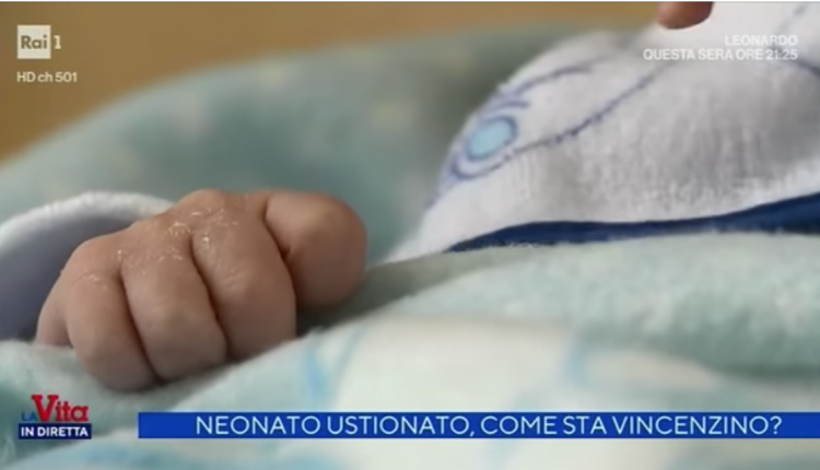 FORZA VINCENZINO – Le condizioni del bimbo porticese ricoverato al Santobono continuano a migliorare, si attende il trapianto della cute. Il tribunale per i minori dispone la figura di un tutore, potrebbe essere il sindaco Vincenzo Cuomo