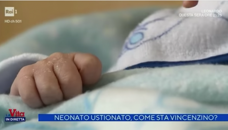 Neonato ustionato a Portici, i genitori naturali di Vincenzino condannati a 6 anni: 4 anni per l’abbandono e 2 anni per le lesioni colpose